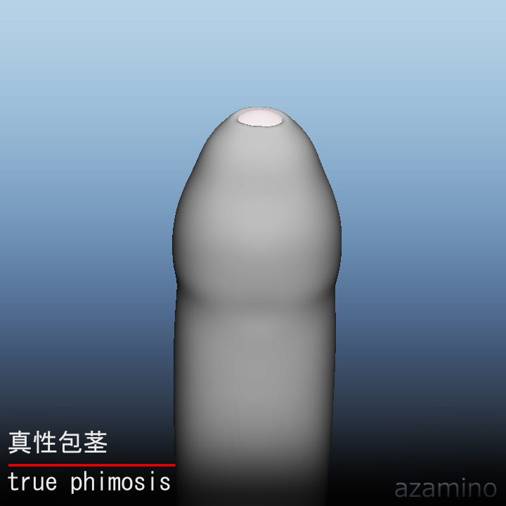 真性包茎