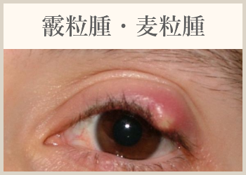 霰粒腫・麦粒腫