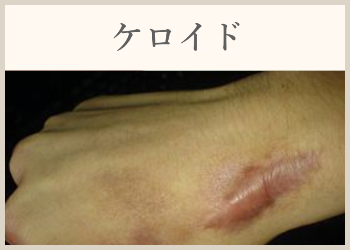 ケロイド