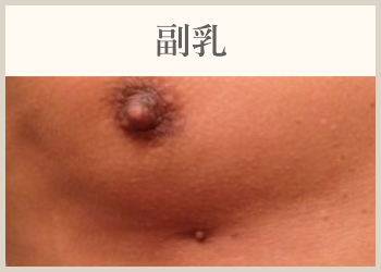 副乳