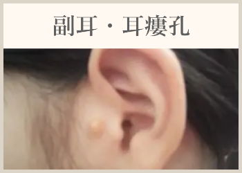 副耳・耳瘻孔