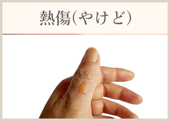 熱傷(やけど)