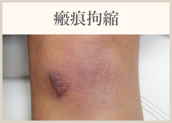 瘢痕拘縮