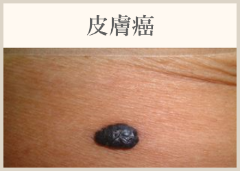 皮膚癌