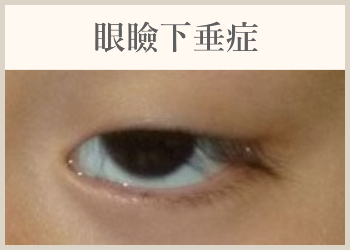 眼瞼下垂症