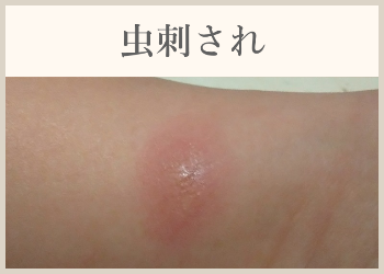 虫刺され