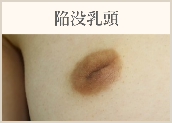陥没乳頭