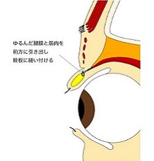 挙筋腱膜前転法