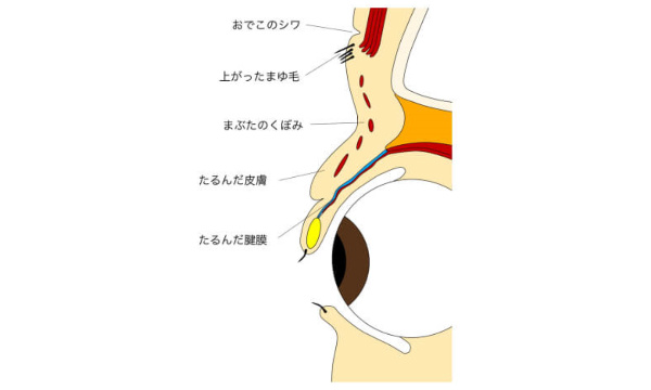 眼瞼下垂症のまぶた