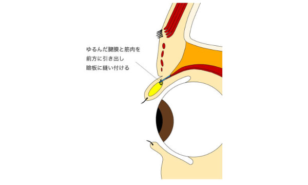 挙筋腱膜前転法
