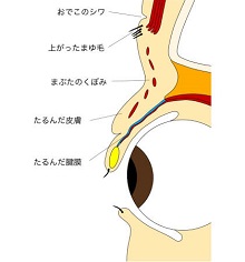 眼瞼下垂症のまぶた