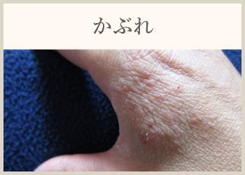 かぶれ