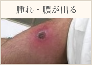 腫れ・膿が出る