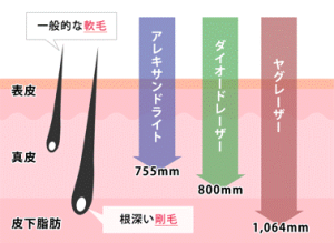 脱毛の原理