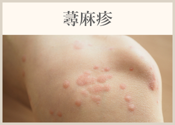 蕁麻疹