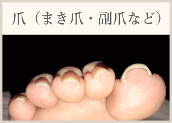 爪（まき爪・副爪など）