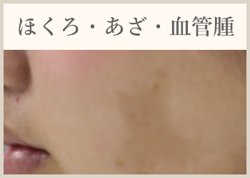 ほくろ・あざ・血管腫