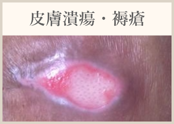 皮膚潰瘍・褥瘡