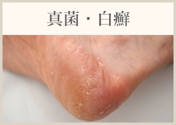 真菌・白癬